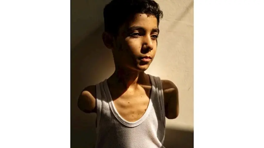 تعكس أصداء الحرب.. صورة طفل فلسطيني مبتور الذراعين تفوز بجائزة العام
