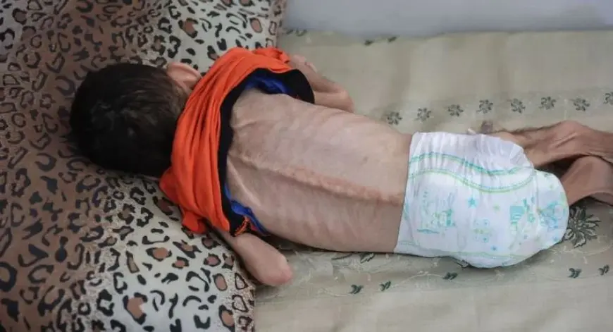 وفاة طفل في غزة بسبب سوء التغذية