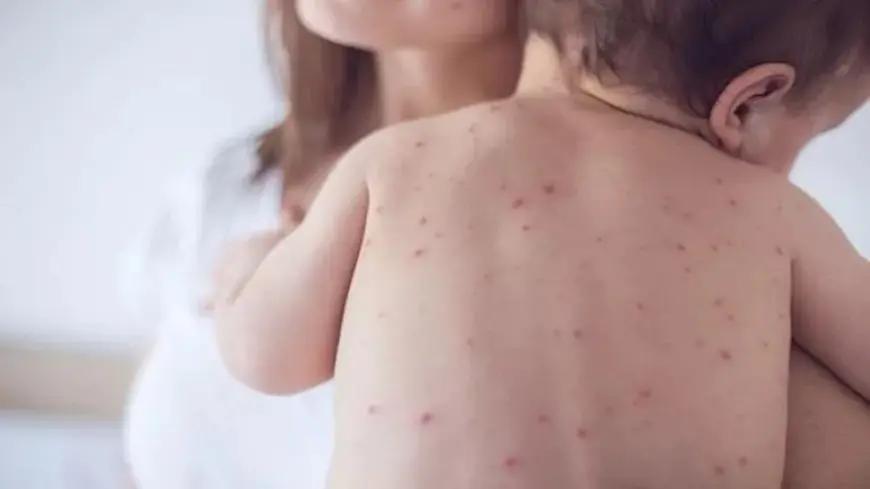 تفشي الحصبة ينحسر في أميركا.. وميشيغان وبنسلفانيا خاليتان رسميًا من المرض