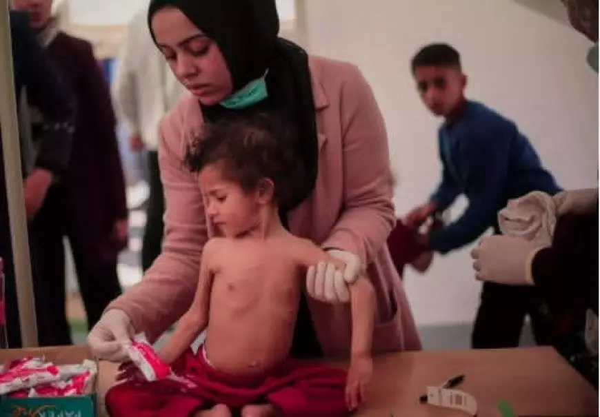 هياكل عظمية على أسِرّة المستشفيات.. الجوع ينهش صغار غزة وسط حصار إسرائيلي خانق