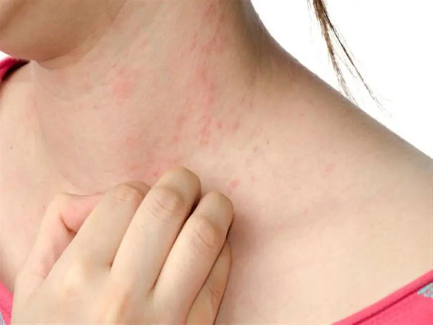 أمراض الجلد في الصيف.. عندما يتحول الحر والرطوبة إلى تهديد لصحة البشرة