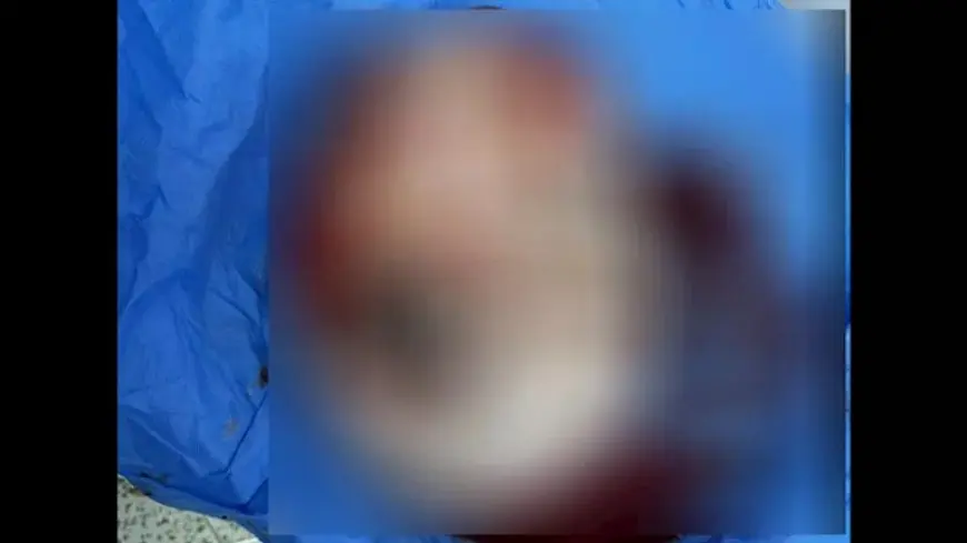 إنجاز طبي لمستشفى الأزهز بأسيوط.. استئصال ورم مبيضي بوزن 7 كجم