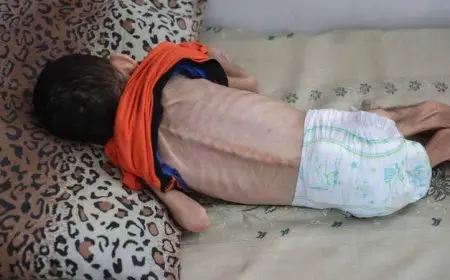 شهداء الجوع في غزة.. 7 وفيات جديدة جراء التجويع وسوء التغذية