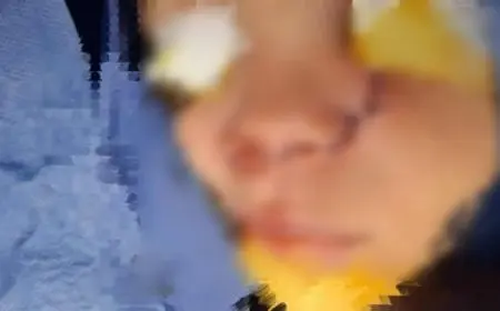 بعد جرح قطعي.. فريق جراحي بمستشفى قها التخصصي ينجح في إعادة أنف طفلة لطبيعتها