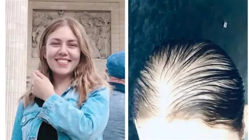 بعد سقوط شعرها وإصابتها بالصلع.. رحمة حسن: “إحنا مش فئران تجارب”