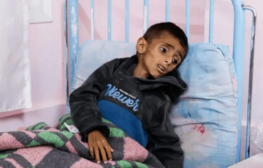 نتيجة الحرب والتجويع.. متلازمة غيلان باريه تفتك بأطفال غزة