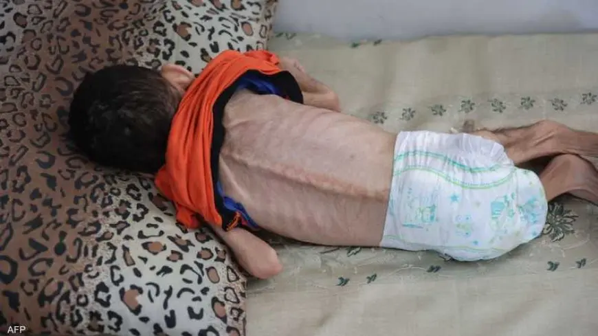 شهداء الجوع في غزة.. 7 وفيات جديدة جراء التجويع وسوء التغذية