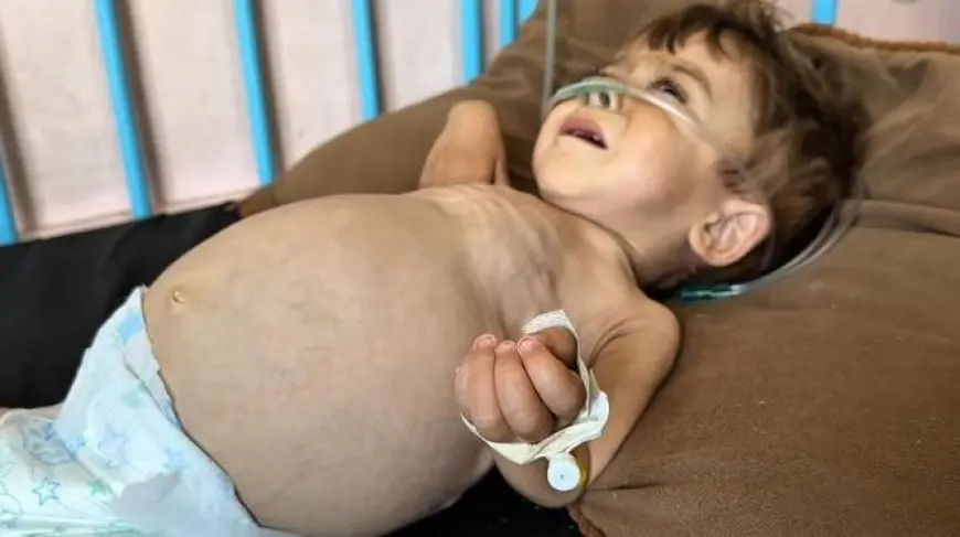 كريم.. طفل بغزة بين فكي مرض نادر وتجويع إسرائيلي