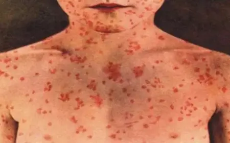 اليمن: 20 وفاة وأكثر من 7300 إصابة بالحصبة والكوليرا في تعز