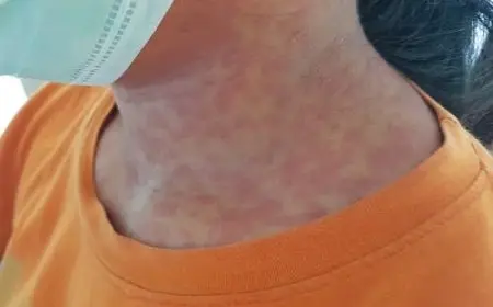 الفارق بين الحصبة والحصبة الألمانية ومخاطرها على الأطفال والحامل