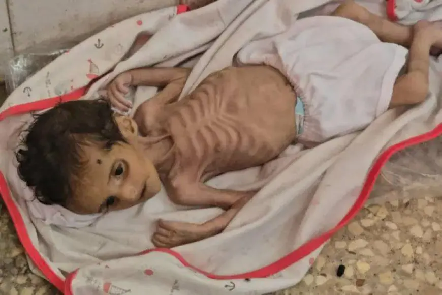 صحة غزة: تسجيل 5 حالات وفاة نتيجة المجاعة وسوء التغذية خلال ـ24 ساعة