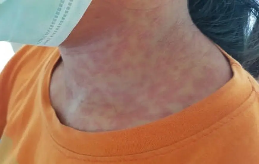 الفارق بين الحصبة والحصبة الألمانية ومخاطرها على الأطفال والحامل