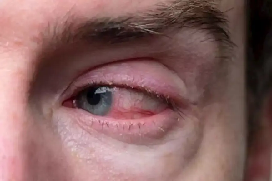 دراسة: إهمال جفاف العين قد يؤدي إلى فقدان البصر